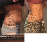25-34 year old female treated with SculpSure