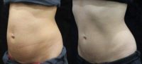 25-34 year old Houston woman treated with SculpSure