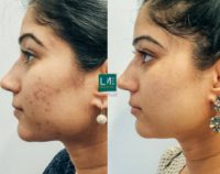 25-34 year old woman treated with Acne Treatment