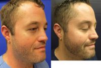28-year-old man treated with Sculptra Aesthetic