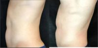25-34 year old man treated with Emsculpt
