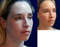 25-34 year old woman treated with Sculptra Aesthetic
