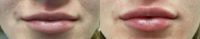 25-34 year old woman treated with Restylane Defyne