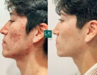 25-34 year old man treated with Acne Scars Treatment