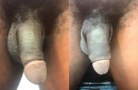 25-34 year old man treated with Penis Enlargement