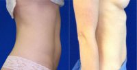 25-34 year old woman treated with CoolSculpting