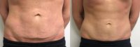 25-34 year old man treated with truSculpt iD
