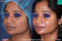 25-34 year old woman treated with Laser Treatment