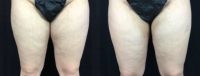 25-34 year old woman treated with BodyTite of the inner thighs, also know as a Smooth Thigh Lift