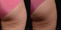 25-34 year old woman treated with CoolSculpting to the outer thighs