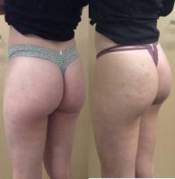25-34 year old woman treated with Radiesse
