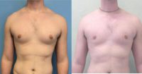 25-34 year old man treated with Gynecomastia Surgery 1 month Result