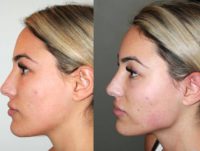 25-34 year old woman treated with Liquid Facelift