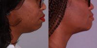 25-34 year old woman treated with Chin Implant