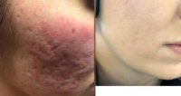 25-34 year old woman treated with CO2 Laser