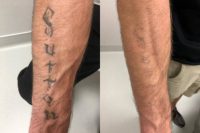 25-34 year old male treated with Tattoo Removal