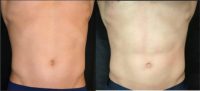 25-34 year old man treated with Emsculpt