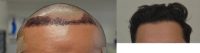 25-34 year old man treated with FUE Hair Transplant