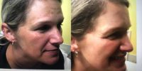 25-34 year old woman treated with Cosmelan