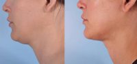 25-34 year old woman treated with Neck Liposuction