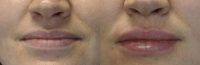 34 year old woman treated with one syringe of Juvederm Ultra Plus XC to the lips