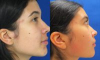 25-34 year old woman treated with Buccal Fat Removal