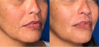 35-44 year old woman treated Smile Lines with Injectable Fillers