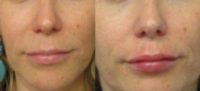 35-44 year old woman treated with Lip Augmentation