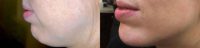 35-44 year old woman treated with Chin, Jaw and Lip Fillers