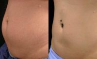 35-44 year old woman treated with CoolSculpting