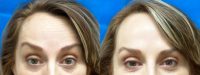 35-44 year old woman treated with Botox for Migraines