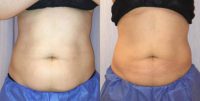 35-44 year old woman treated with CoolSculpting