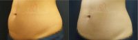 35-44 year old woman treated with WarmSculpting with SculpSure