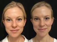 37 year old woman treated with Botox