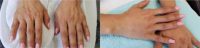 35-44 year old woman treated with Hand Rejuvenation