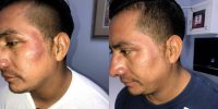 35-44 year old man treated with Laser Peel