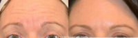35-44 year old woman treated with Botox to the Forehead
