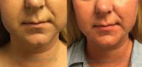 35-44 year old woman treated with Kybella for double chin reduction