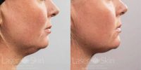 35-44 year old woman treated with CoolSculpting CoolMini to Double Chin Fat
