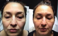 35-44 year old woman treated with Vampire Facelift