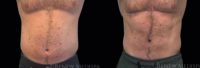 35-44 year old man treated with Emsculpt