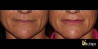 35-44 year old woman treated with Restylane for Lip Line and Lip Volume
