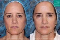 35-44 year old woman treated with Laser Resurfacing