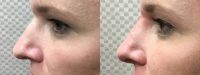 35-44 year old woman treated with Restylane