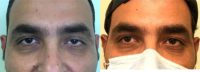 35-44 year old man treated with Ptosis Surgery