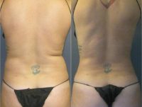 35-44 year old woman treated with Tumescent Liposuction