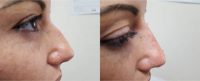 35-44 year old woman treated with Non Surgical Nose Job