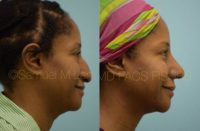 42 year old woman treated with Rhinoplasty