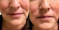 35-44 year old woman treating Smile lines with Injectable Fillers