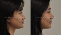 35-44 year old woman treated with Nonsurgical Nose Job with Restylane Lyft